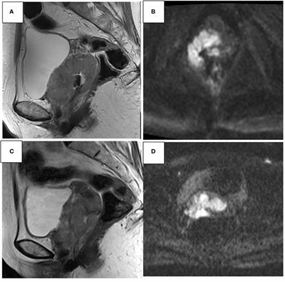 Post treatment imaging in patients with local advanced cervical carcinoma